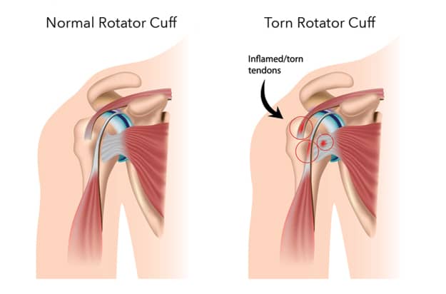 Supraspinatus Tear Exercises To Avoid / Top 3 Rotator Cuff Exercises Fix Your Shoulder Pain